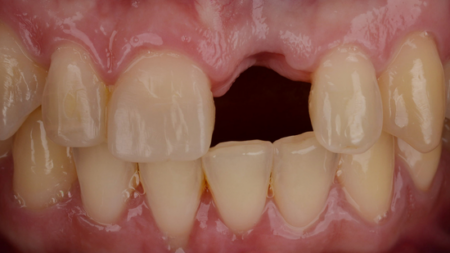 Before (Teeth)