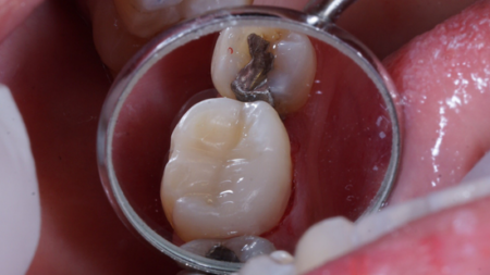 After (Teeth)