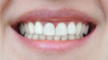 After (Teeth)
