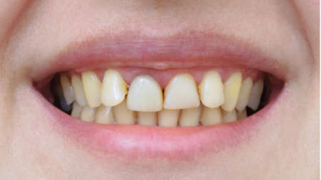 Before (Teeth)
