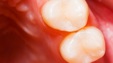 After (Teeth)