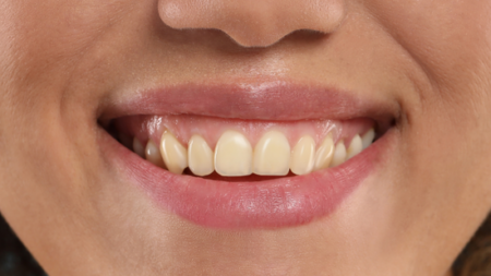 Before (Teeth)