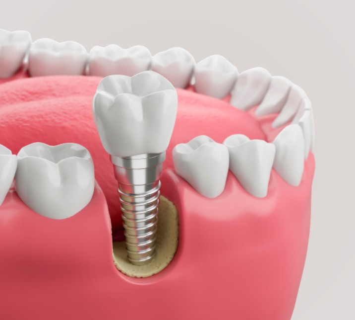 About Dental Implants